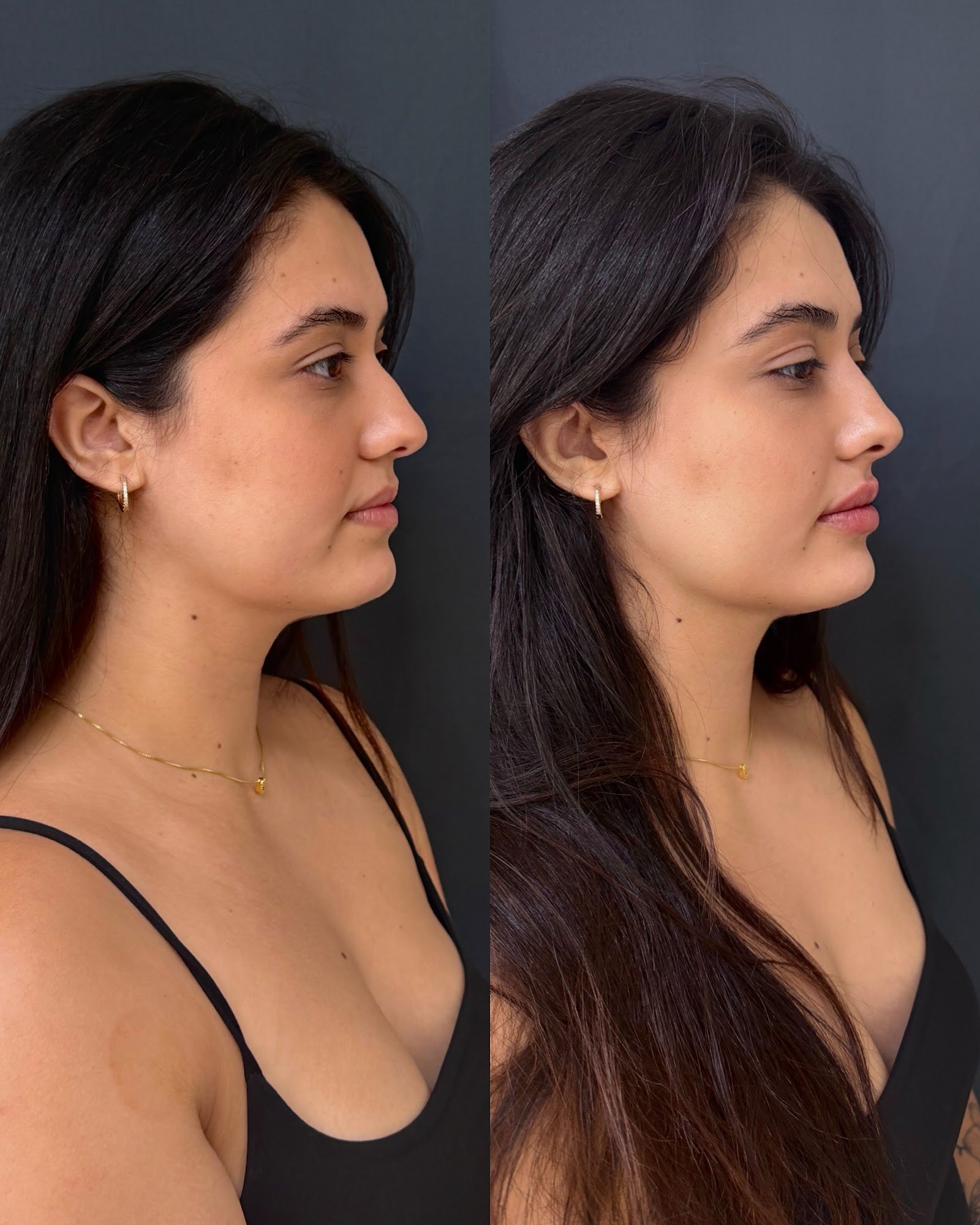 Composição completa de antes e depois de harmonização facial — caso 1