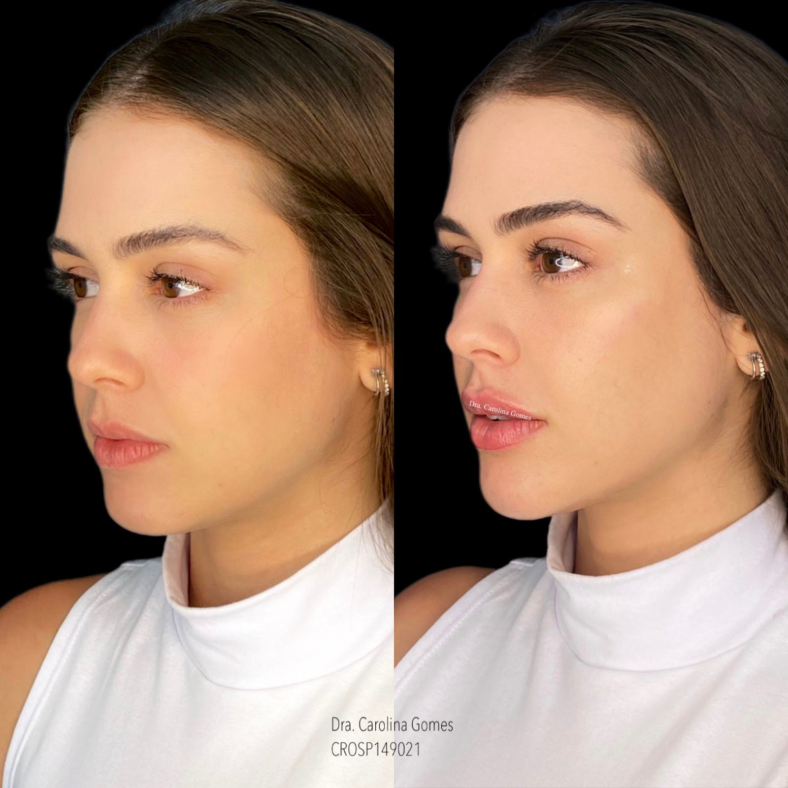 Composição completa de antes e depois de harmonização facial — caso 2