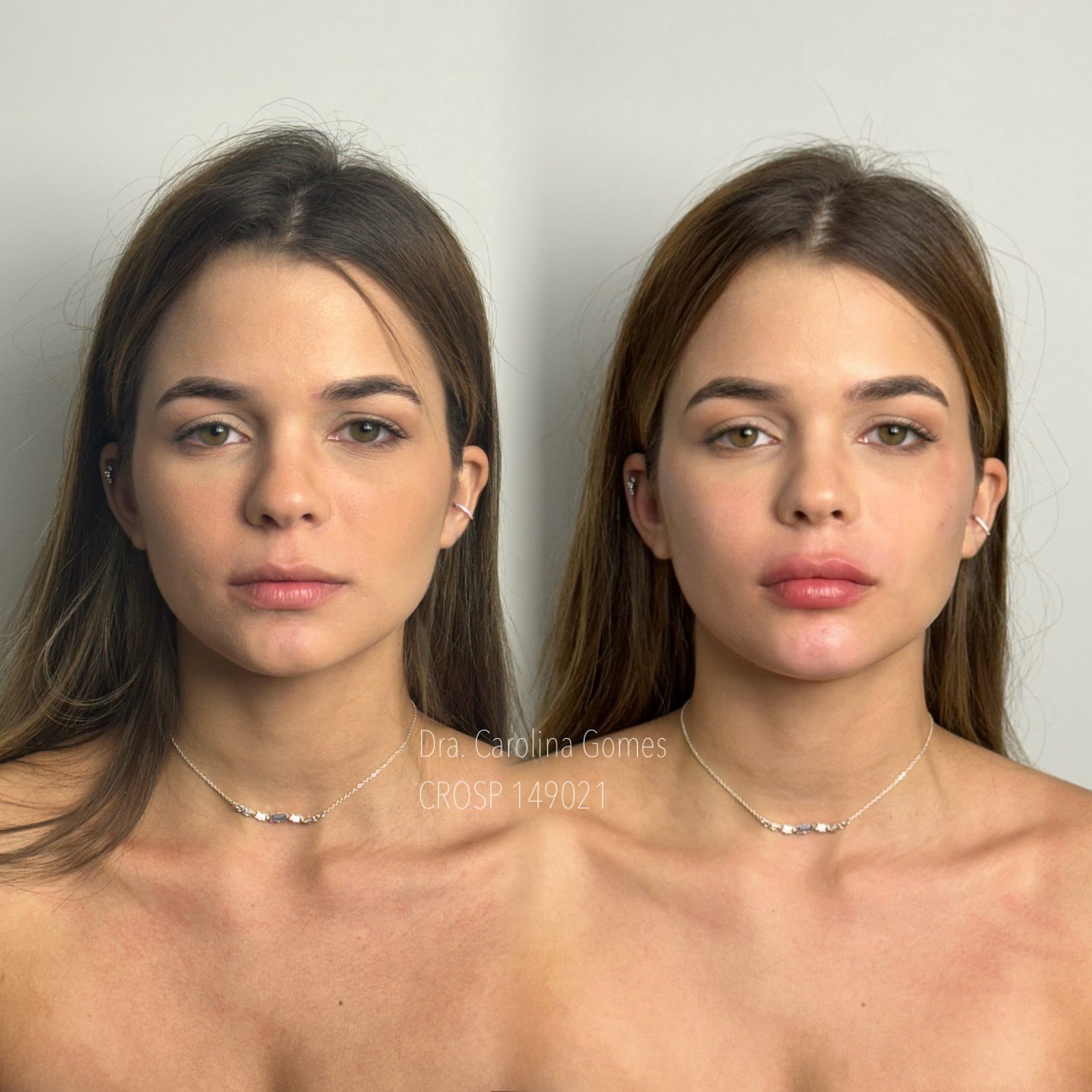 Composição completa de antes e depois de harmonização facial — caso 3