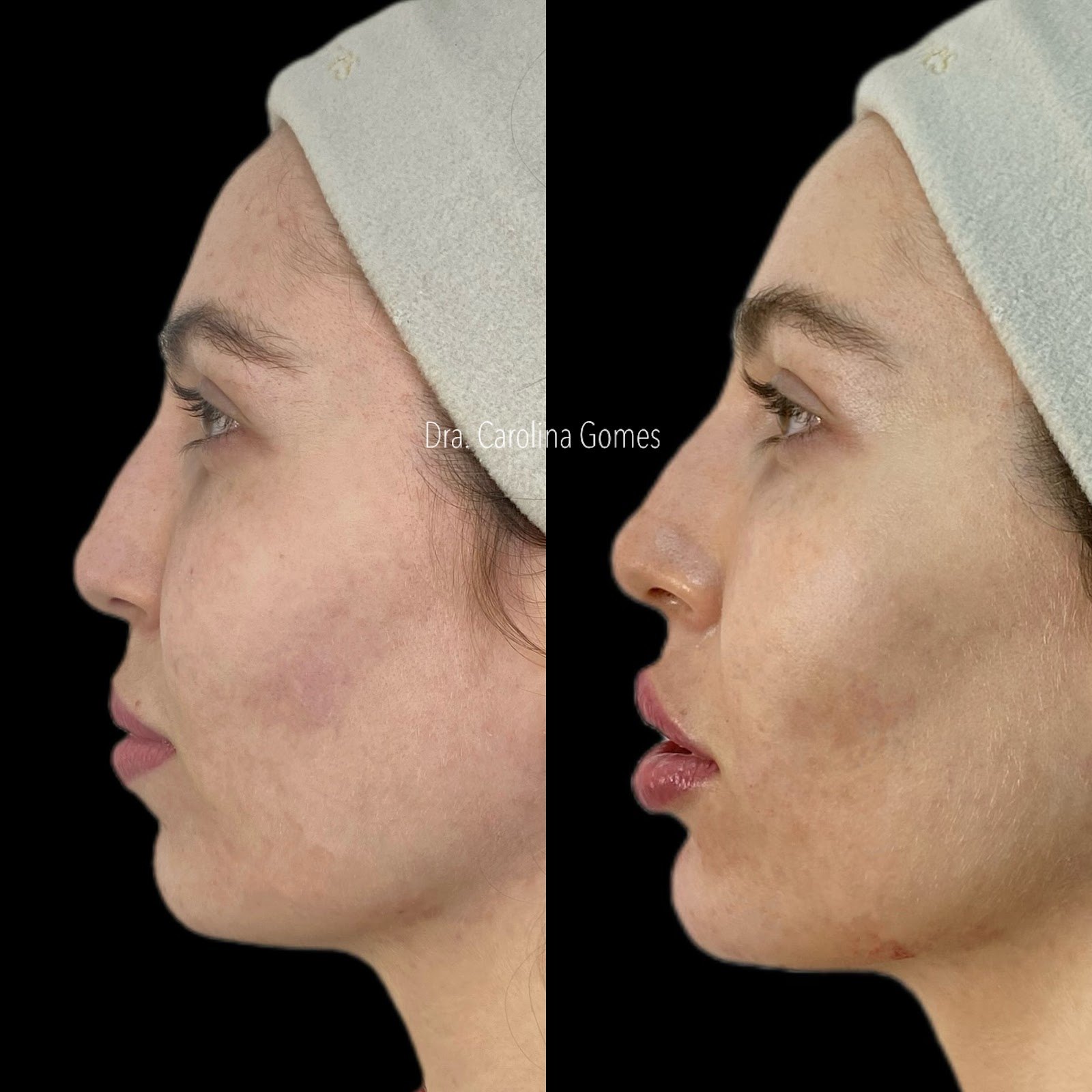 Composição completa de antes e depois de harmonização facial — caso 4