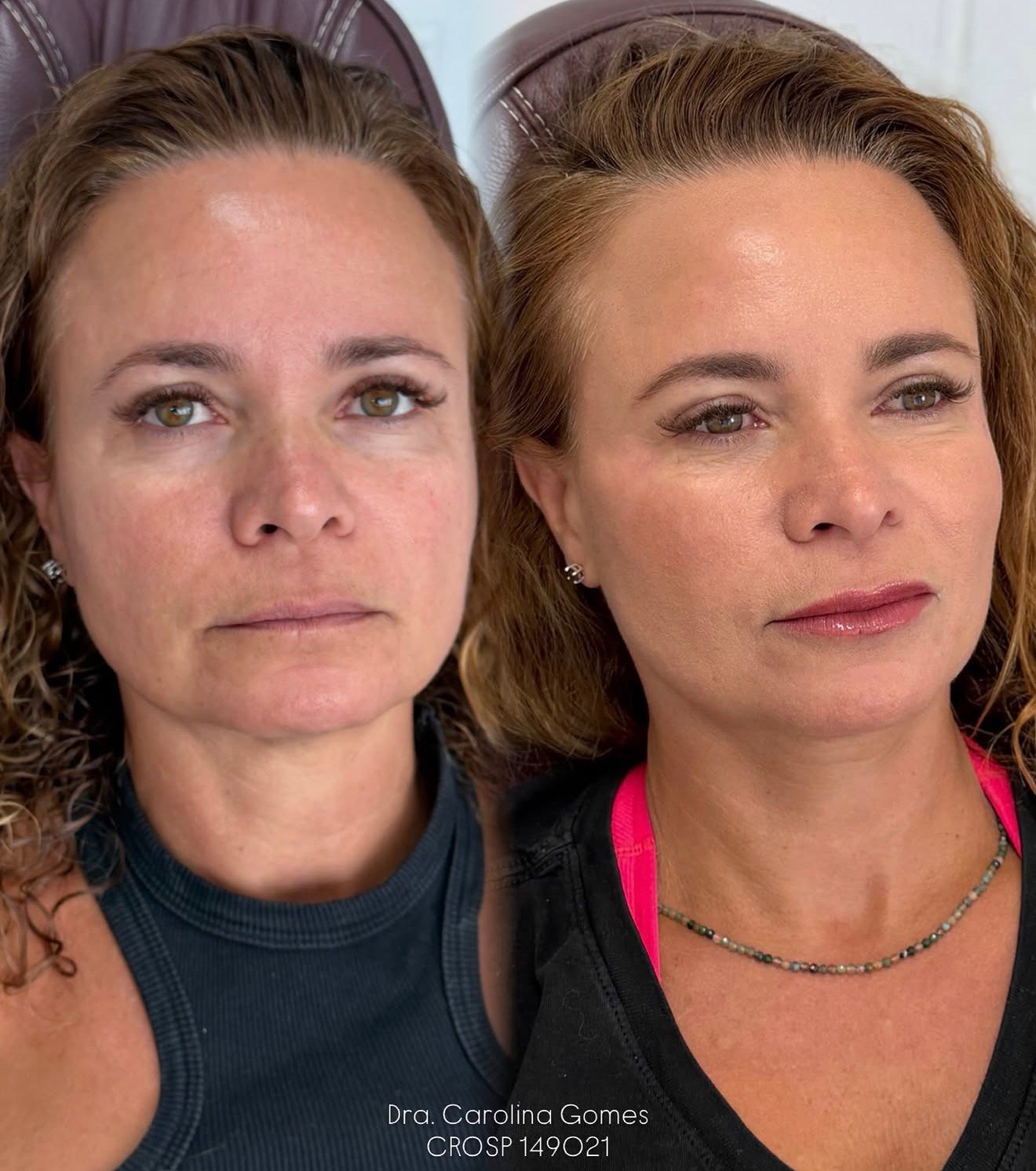 Composição completa de antes e depois de harmonização facial — caso 5