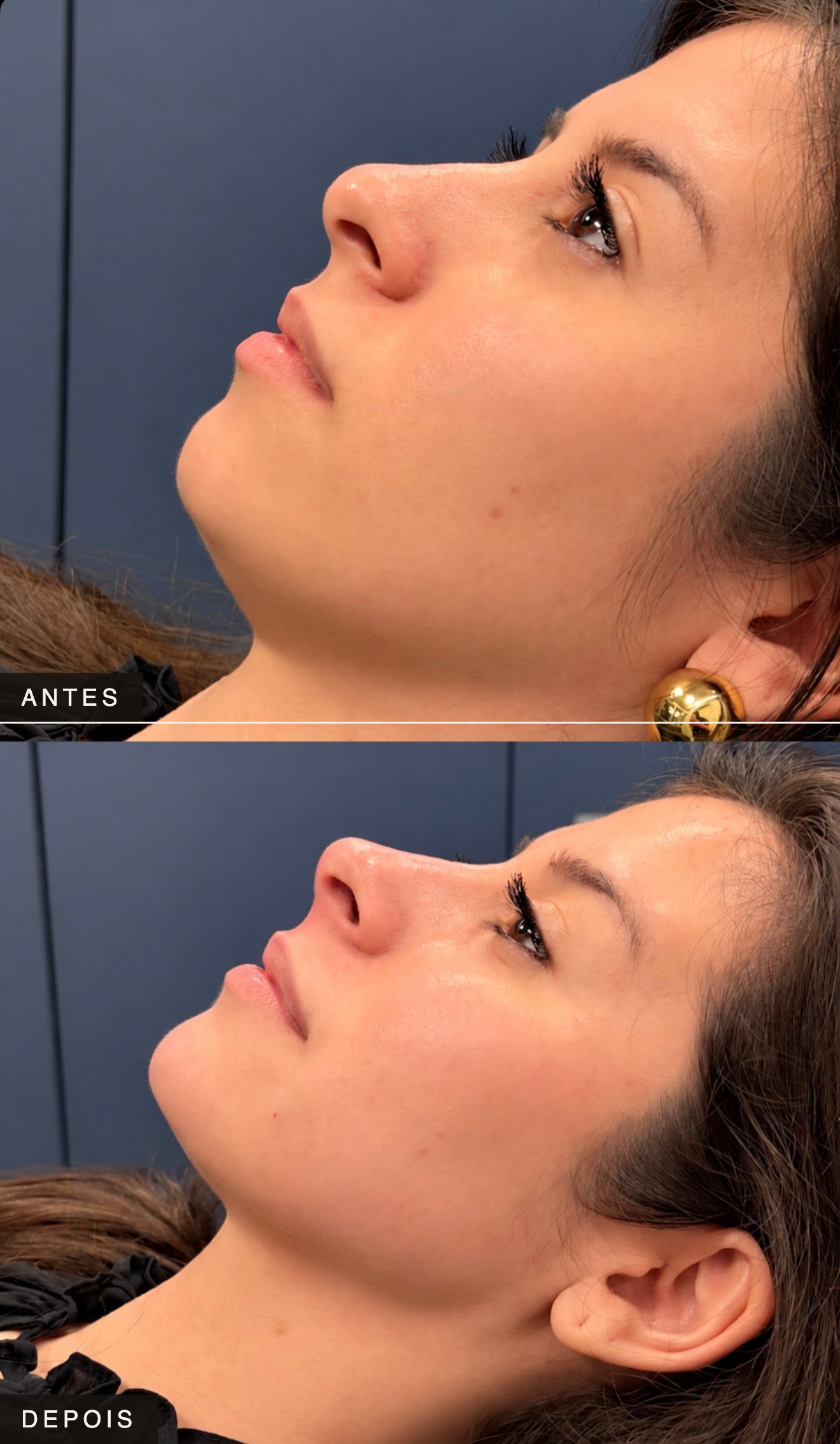 Composição completa de antes e depois de harmonização facial — caso 6