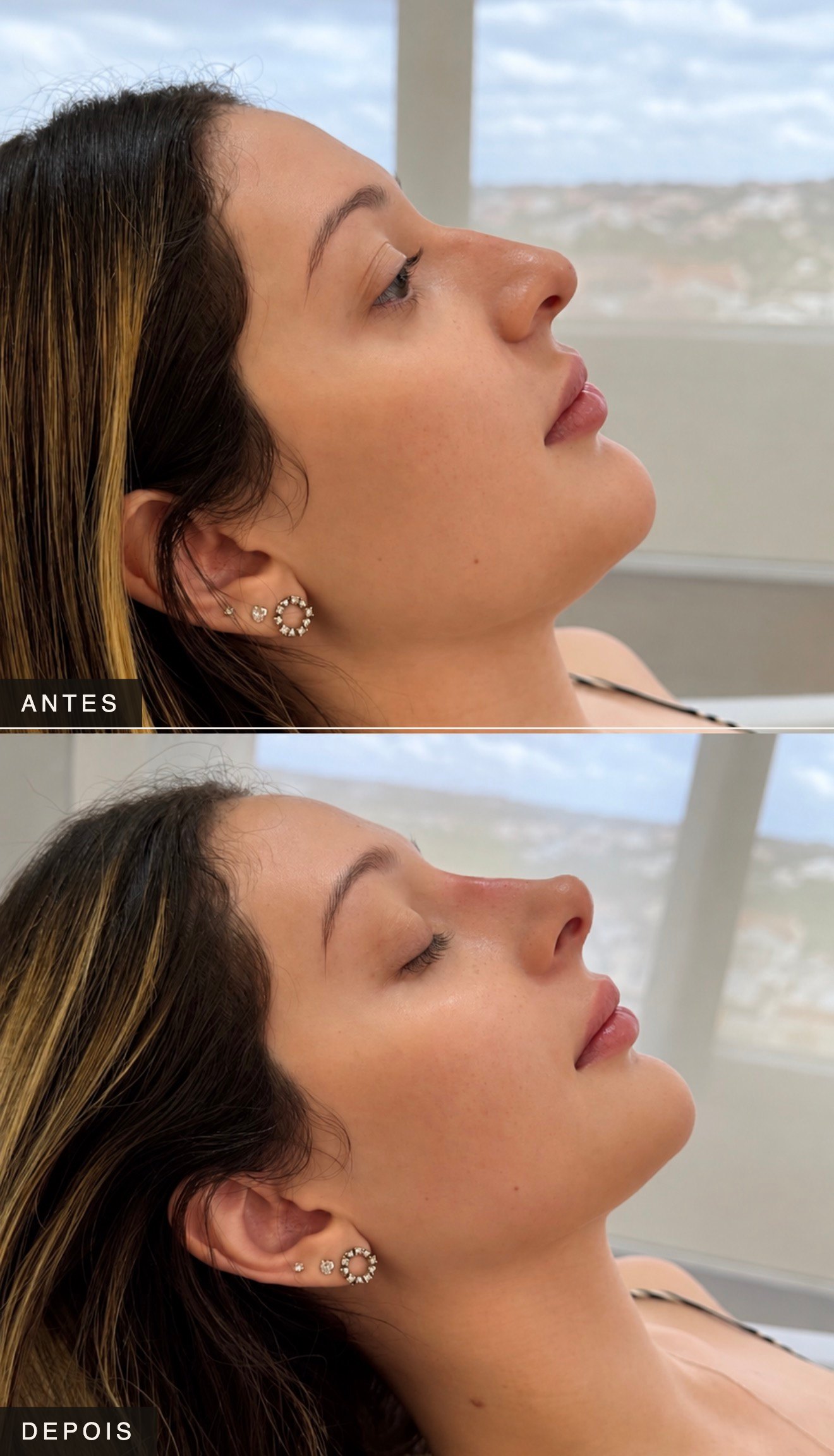 Composição completa de antes e depois de harmonização facial — caso 7