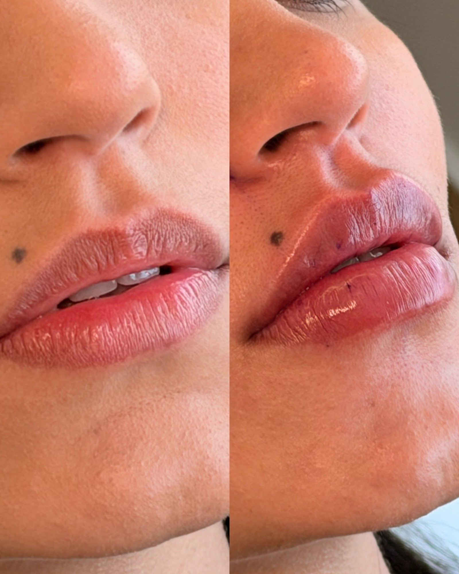 Composição completa de antes e depois de preenchimento labial — caso 1