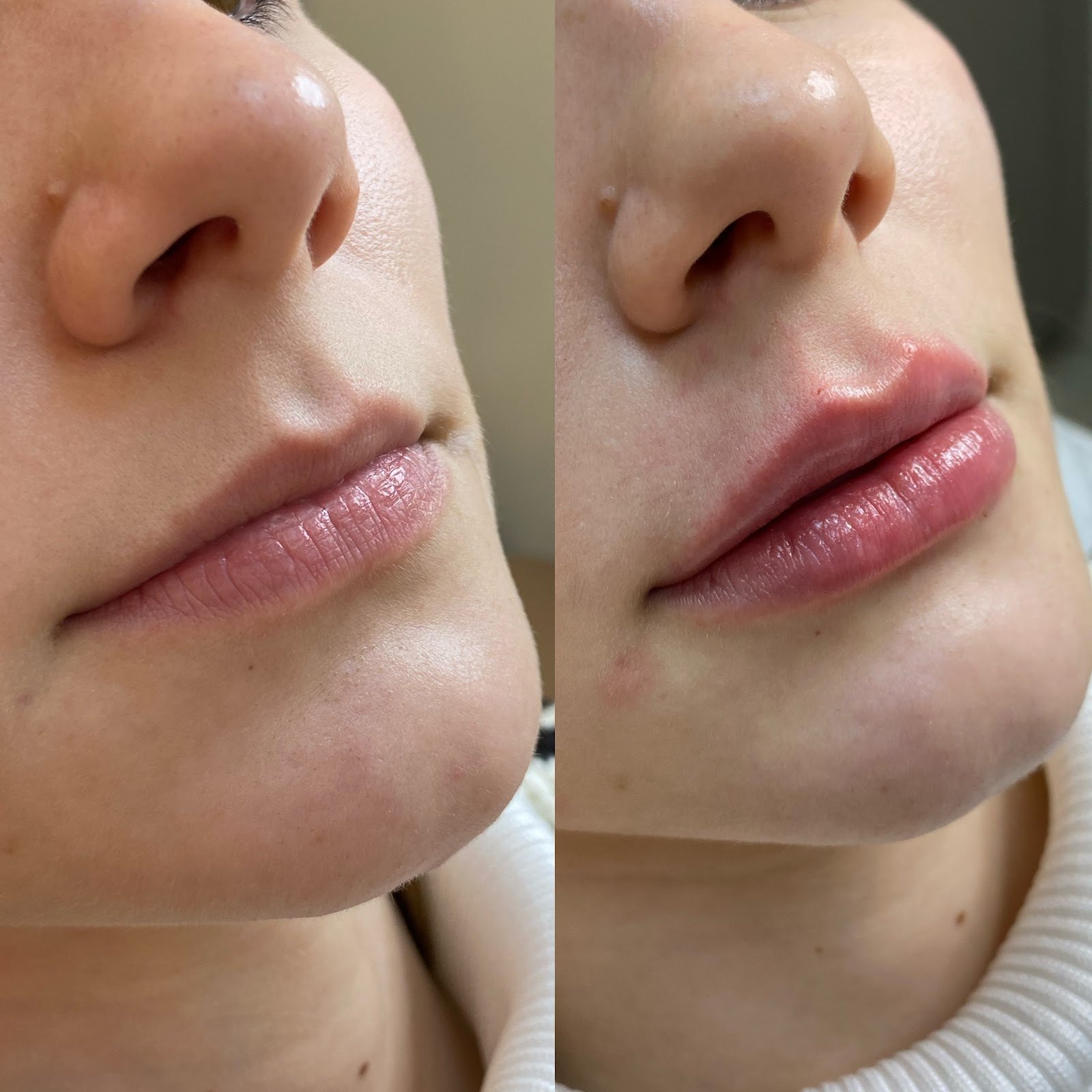 Composição completa de antes e depois de preenchimento labial — caso 2