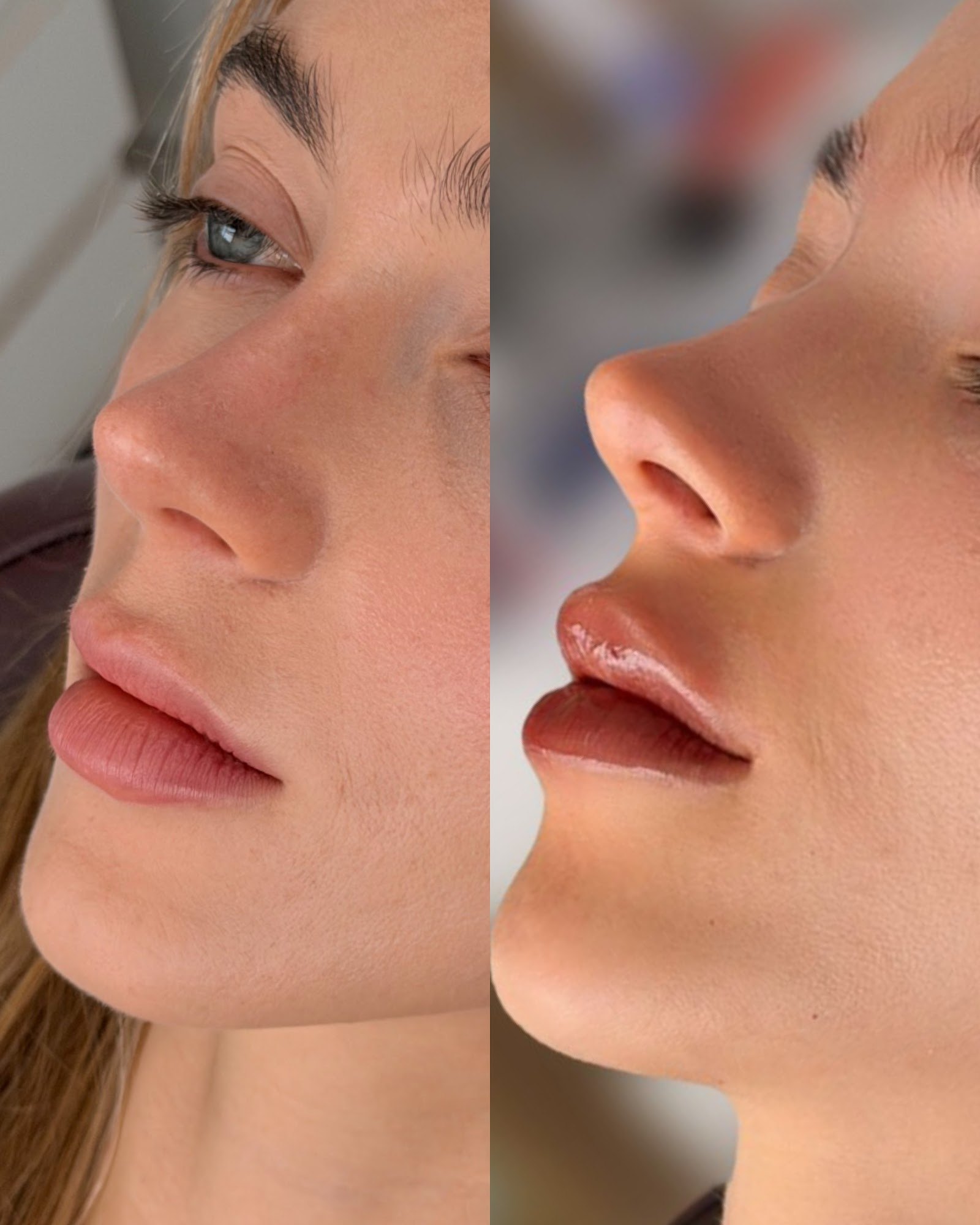 Composição completa de antes e depois de preenchimento labial — caso 3