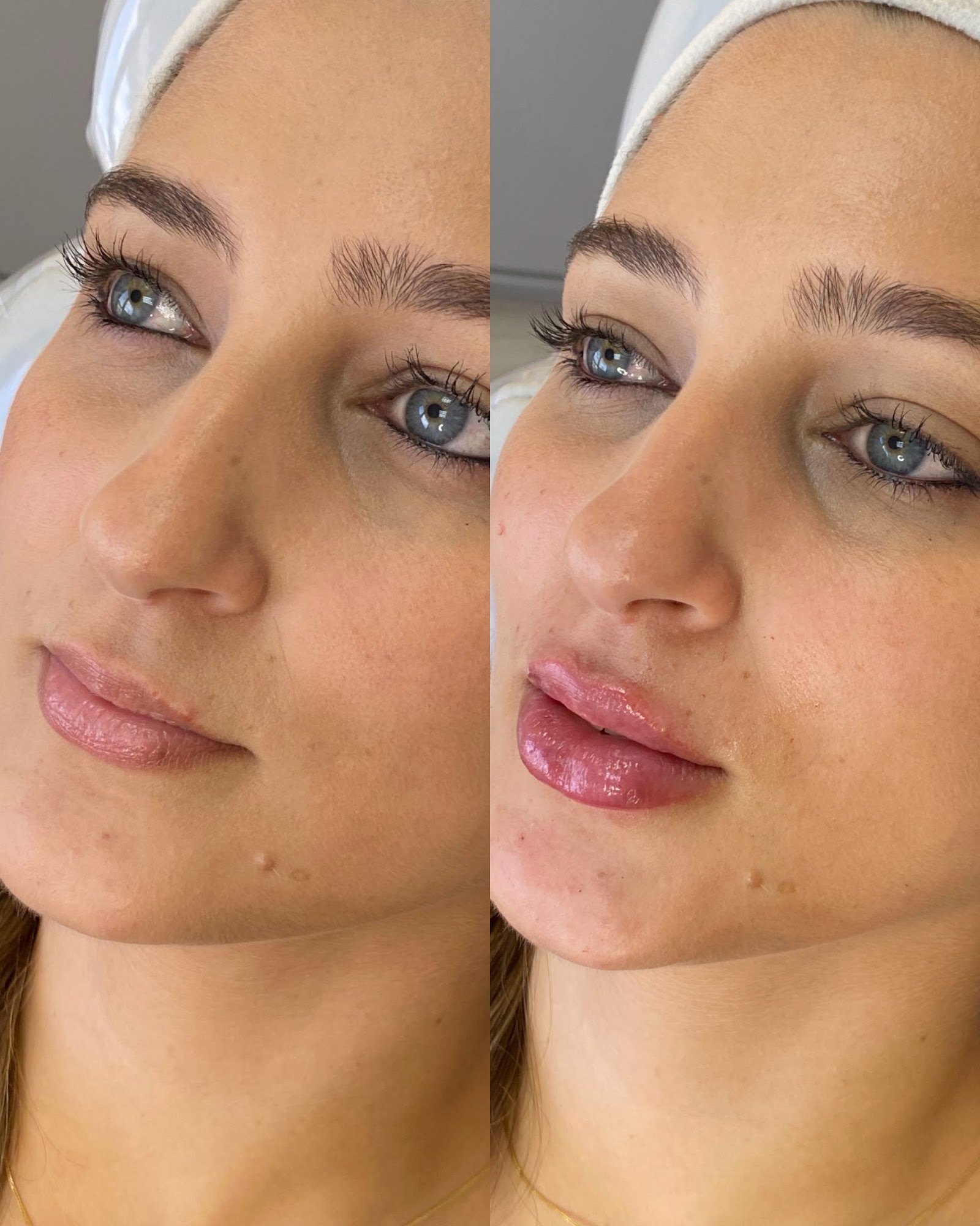 Composição completa de antes e depois de preenchimento labial — caso 4