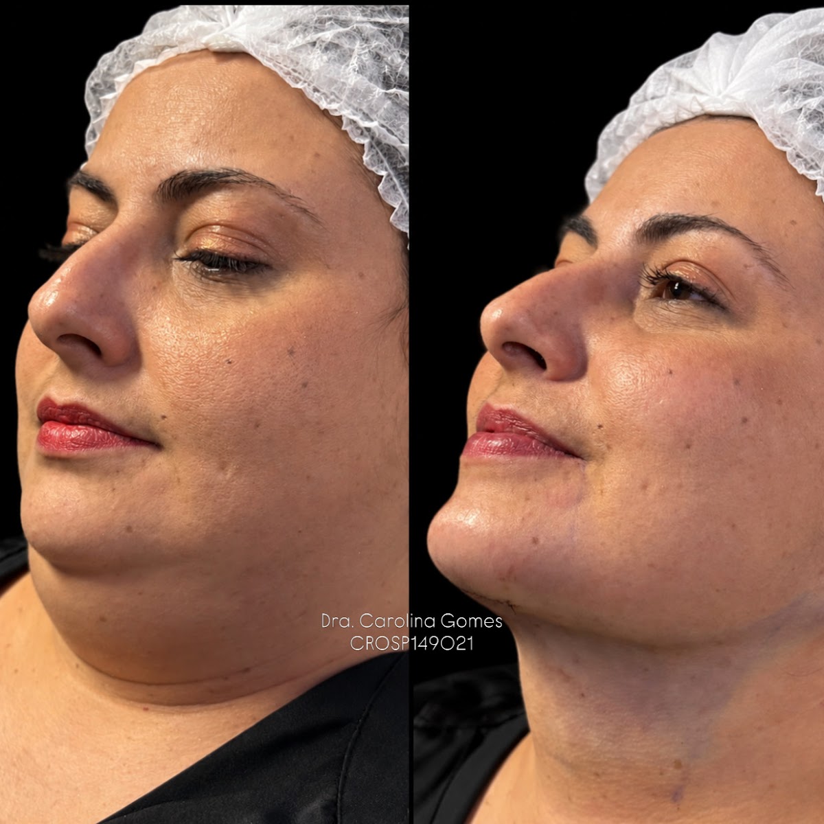 Composição completa de antes e depois de lipo de papada — caso 1