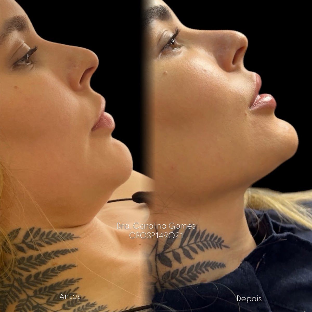 Composição completa de antes e depois de lipo de papada — caso 2