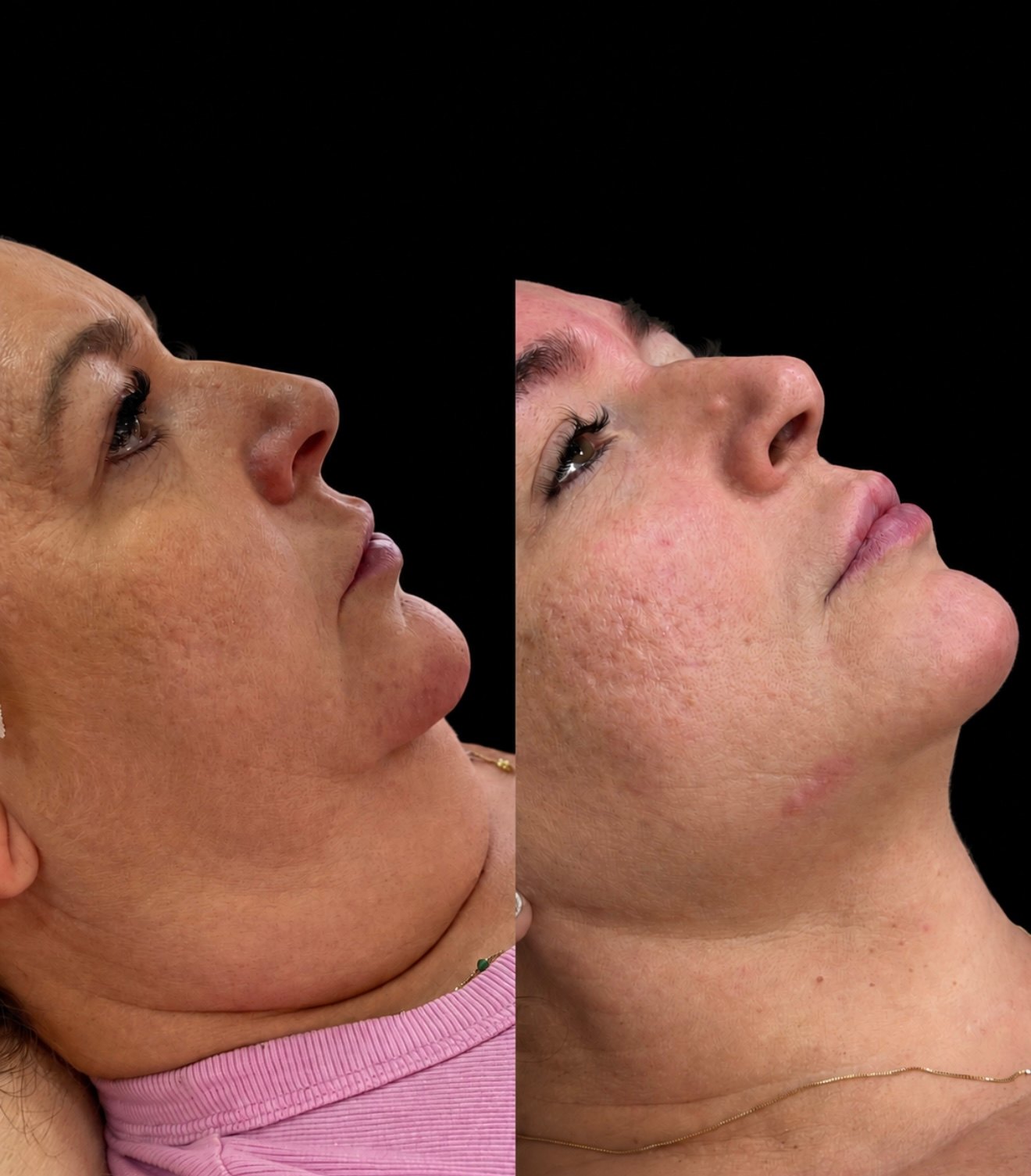 Composição completa de antes e depois de lipo de papada — caso 4