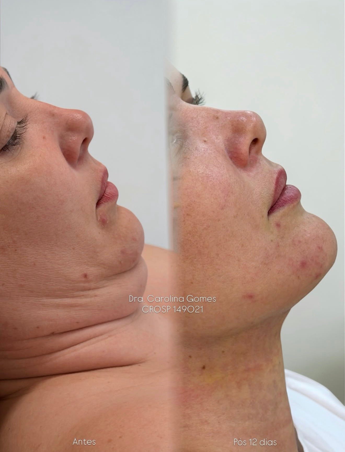Composição completa de antes e depois de lipo de papada — caso 5