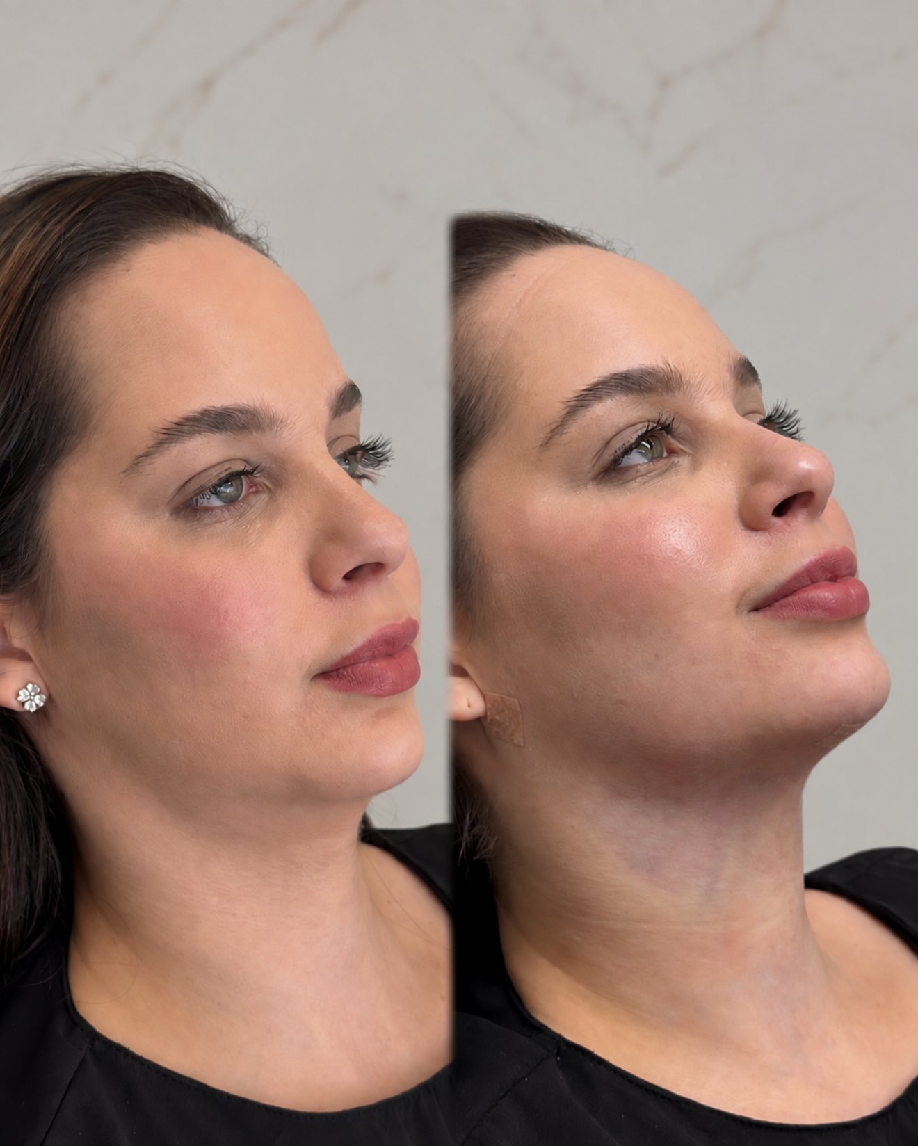 Composição completa de antes e depois de lipo de papada — caso 6