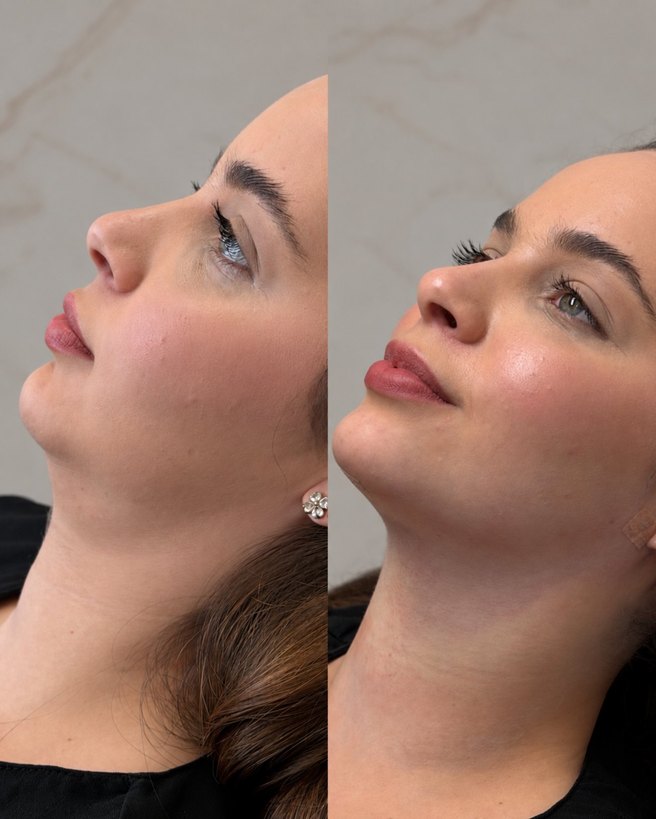 Composição completa de antes e depois de lipo de papada — caso 7