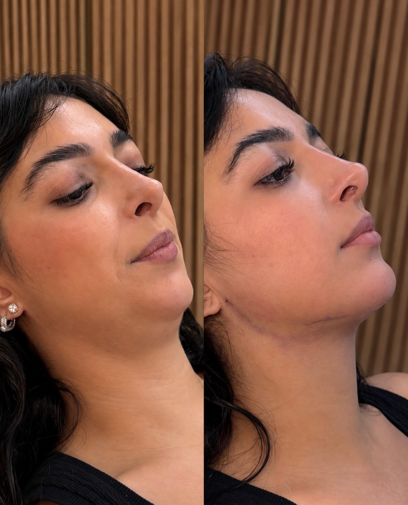 Composição completa de antes e depois de lipo de papada — caso 8