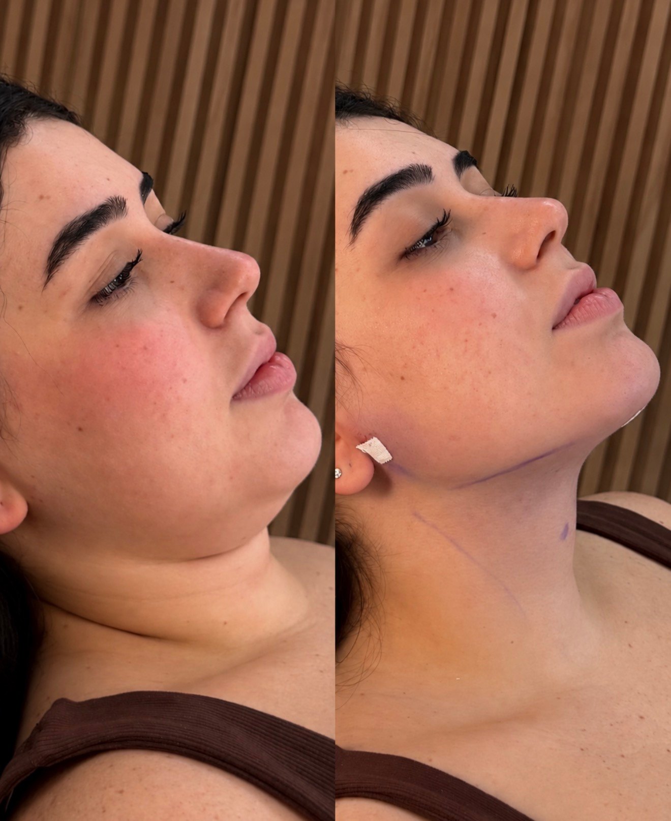 Composição completa de antes e depois de lipo de papada — caso 9